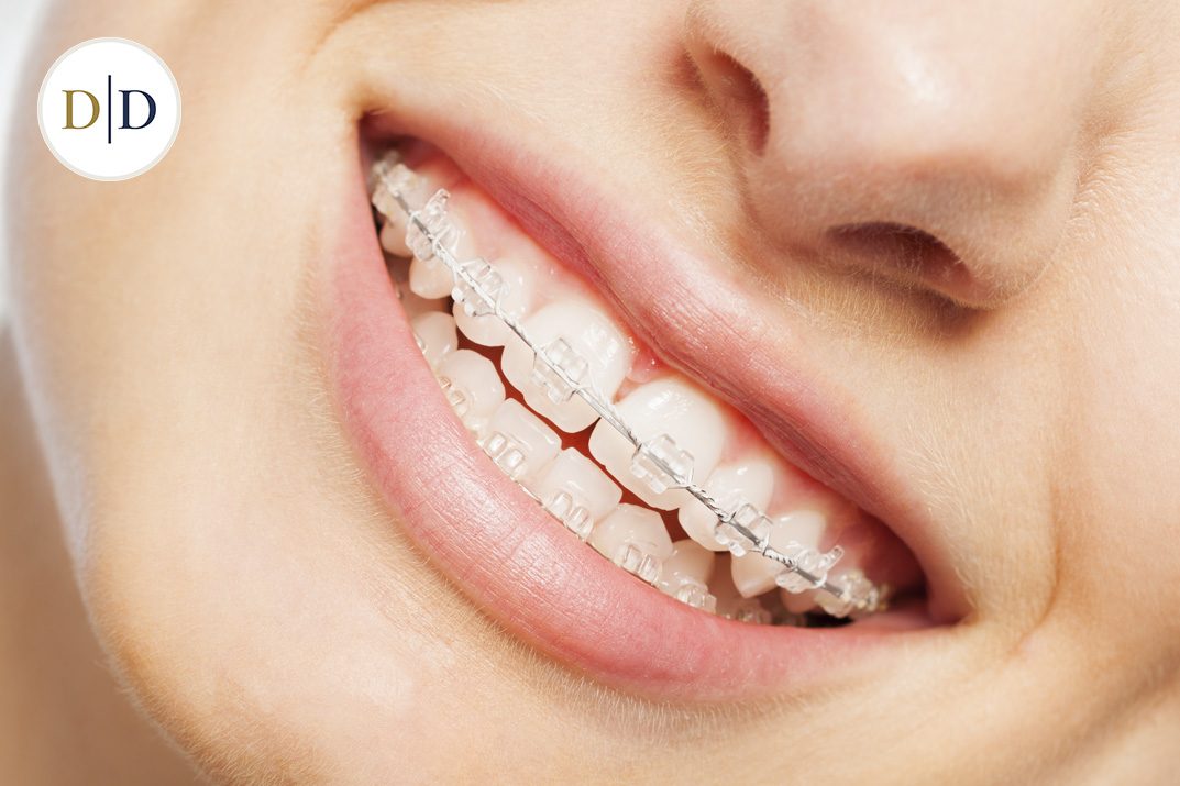 Ceramic braces