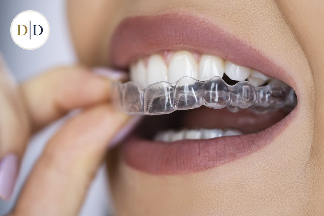 Clear aligner tray