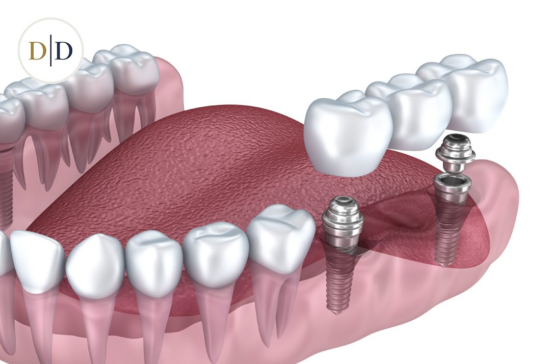 Implant-supported bridge replacing several missing teeth