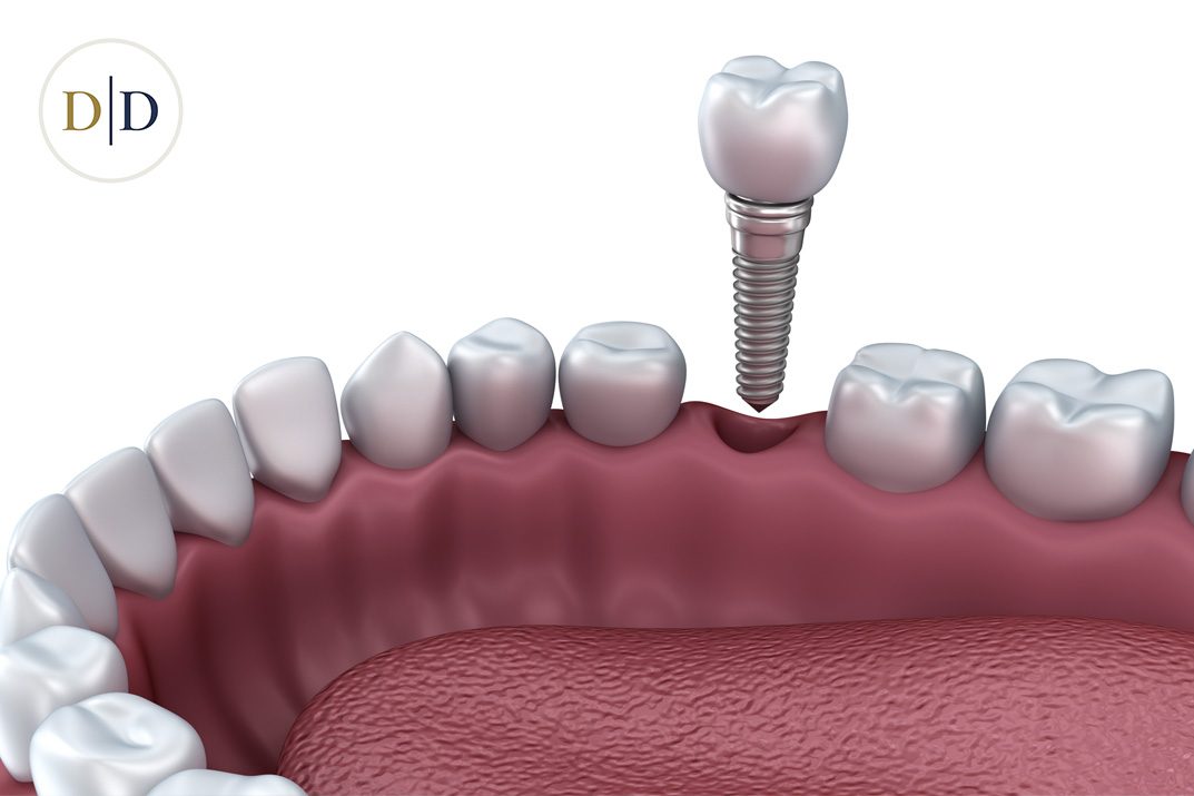 Single dental implant replacing one missing tooth